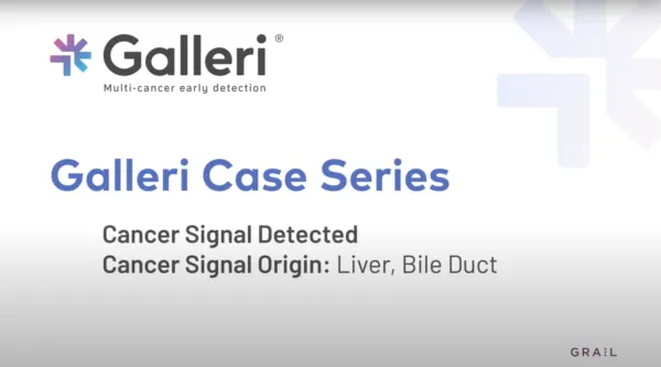 Video still of Galleri Case Series with Dr. Poliak indicating a cancer signal detected with a cancer signal origin of liver, bile duct